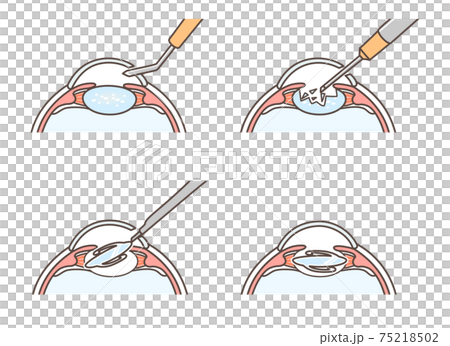 Illustration of cataract surgery 75218502