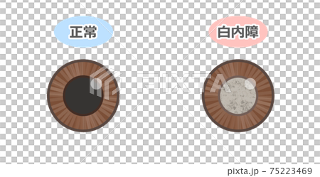 Cataract black eyes 75223469