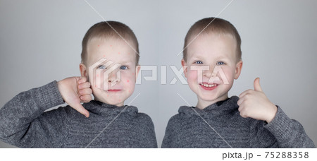 Before and after. The child shows a face with a lot of red allergic acne. The second picture shows a clean face without any allergies. The concept of the treatment of children's rashes. Chickenpox Before and after. The child shows a face with a lot of red allergic acne. The second picture shows a clean face without any allergies. The concept of the treatment of children's rashes. Chickenpox 75288358