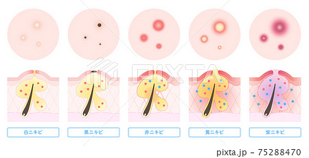 ニキビの種類と肌断面図のイラストのイラスト素材