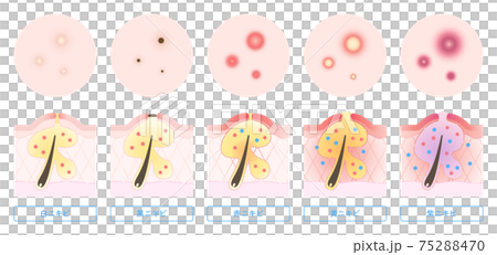 ニキビの種類と肌断面図のイラスト 75288470