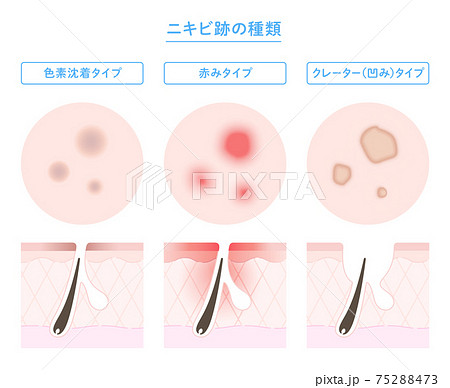 ニキビ跡の種類と肌断面図のイラストのイラスト素材