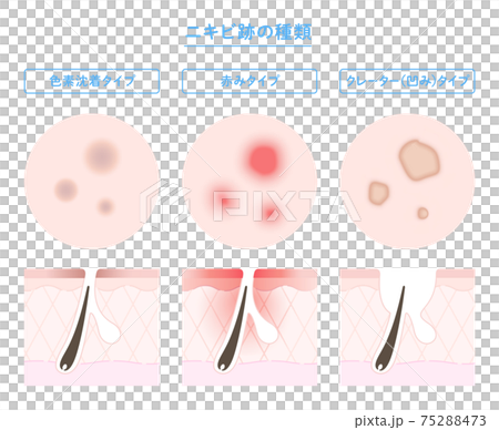 痤瘡疤痕類型和皮膚橫斷面插圖 75288473