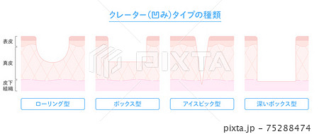 クレータータイプのニキビ跡の種類と肌断面図のイラストのイラスト素材