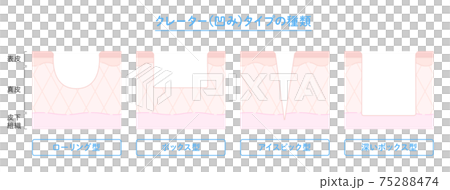 火山口型痤瘡疤痕類型和皮膚橫斷面插圖 75288474