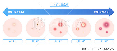 ニキビの種類と重症度のイラストのイラスト素材