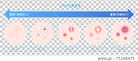 痤瘡類型和嚴重性說明 75288475