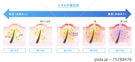 肌断面図で見せるニキビの種類と重症度のイラスト 肌断面図で見せるニキビの種類と重症度のイラスト 75288476