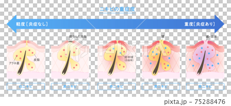 皮膚截面中顯示的痤瘡類型和嚴重程度說明 75288476