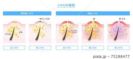 肌断面図で見せるニキビの種類のイラスト 75288477