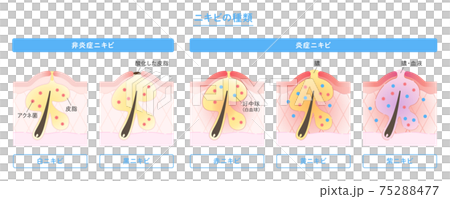 肌断面図で見せるニキビの種類のイラスト 75288477