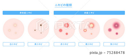肌にできたニキビの種類のイラスト 75288478