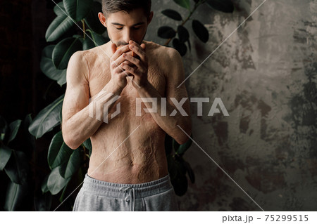 Man with scars at the skin after burn enjoying his coffee while being at home Man with scars at the skin after burn enjoying his coffee while being at home 75299515