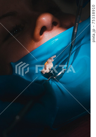 Close-up of the patient's mouth after filling the teeth with white composite resin on the insulation of a rubber dam, rubber dam and dental mirror. Close-up of the patient's mouth after filling the teeth with white composite resin on the insulation of a rubber dam, rubber dam and dental mirror. 75338910