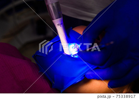 Ultraviolet light in dentistry, treatment of upper masticatory teeth. 75338917