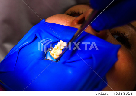 Treatment of the upper sixth left tooth, sterile treatment with roofing felt. 75338918
