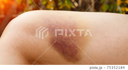 Hematoma and Large Bruise, blood under skin Congestion 75352184