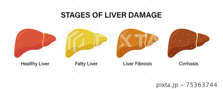 Stages of nonalcoholic liver damage. Healthy, fatty and cirrhosis. Liver Disease. Stages of nonalcoholic liver damage. Healthy, fatty and cirrhosis. Liver Disease. 75363744