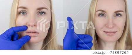 Before and after. A woman examines dry skin on her lips. Peeling, coarsening, discomfort, skin sensitivity. Patient at the appointment of a dermatologist or cosmetologist. Close-up of pieces of dry Before and after. A woman examines dry skin on her lips. Peeling, coarsening, discomfort, skin sensitivity. Patient at the appointment of a dermatologist or cosmetologist. Close-up of pieces of dry 75397264
