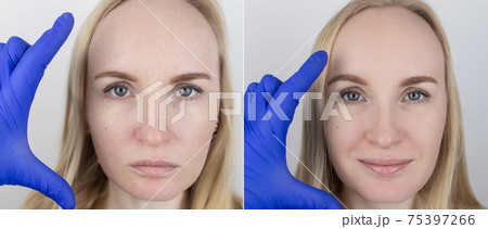 Before and after. A woman examines dry skin on her face. Peeling, coarsening, discomfort, skin sensitivity. Patient at the appointment of a dermatologist or cosmetologist. Close-up of pieces of dry Before and after. A woman examines dry skin on her face. Peeling, coarsening, discomfort, skin sensitivity. Patient at the appointment of a dermatologist or cosmetologist. Close-up of pieces of dry 75397266