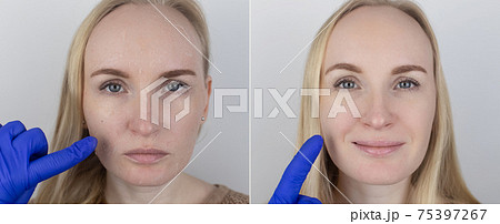 Before and after. A woman examines dry skin on her face. Peeling, coarsening, discomfort, skin sensitivity. Patient at the appointment of a dermatologist or cosmetologist. Close-up of pieces of dry Before and after. A woman examines dry skin on her face. Peeling, coarsening, discomfort, skin sensitivity. Patient at the appointment of a dermatologist or cosmetologist. Close-up of pieces of dry 75397267