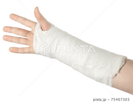 Broken arm, on a white background 75407303