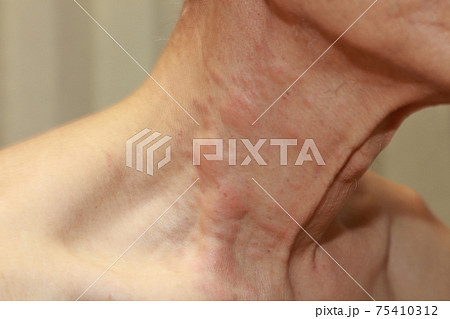 マツカレハ(マツケムシ)に刺されて30時間後の患部 マツカレハ(マツケムシ)に刺されて30時間後の患部 75410312