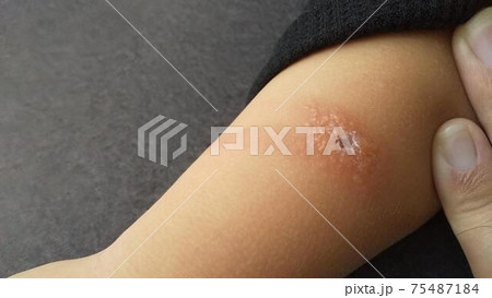 腫れ・虫刺され(やけど虫) 腫れ・虫刺され(やけど虫) 75487184
