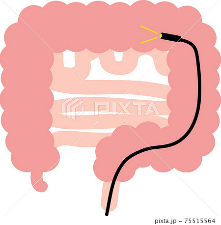 スコープ型 大腸カメラ 検査 スコープ型 大腸カメラ 検査 75515564