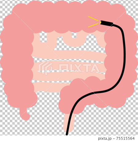內窺鏡結腸鏡檢查 內窺鏡結腸鏡檢查 75515564