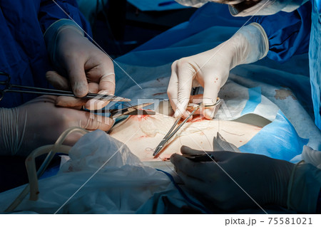 Doctors use medical instruments and metal thread to suture human skin. Doctors use medical instruments and metal thread to suture human skin. 75581021