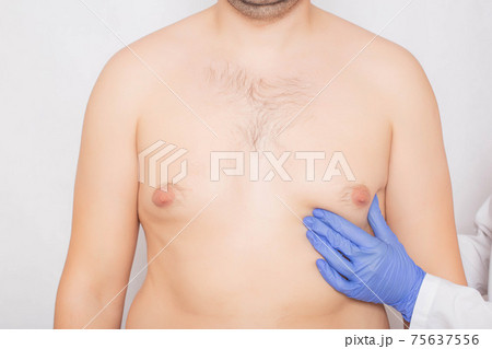 Plastic surgeon doctor examines the male breast before surgery to reduce breast fat, gynecomastia Plastic surgeon doctor examines the male breast before surgery to reduce breast fat, gynecomastia 75637556