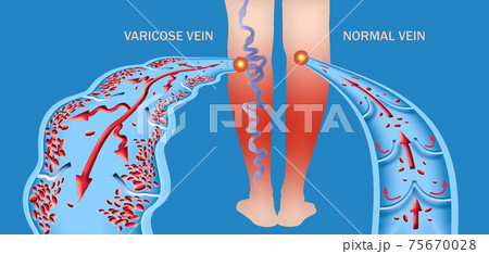 Varicose veins on a female senior legs. The structure of normal and varicose veins. 75670028