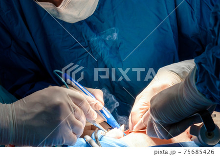 The surgeon holds the electrical coagulator during the operation. The surgeon holds the electrical coagulator during the operation. 75685426