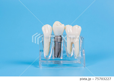 Dental crowns, imitation of a dental prosthesis of a dental bridge with implant 75703227