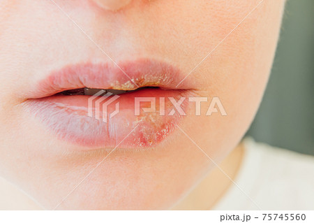 Close up of girl lips affected by herpes. Treatment of herpes infection and virus. Part of young woman face, lips with herpes affected. Beauty dermatology concept. Close up of girl lips affected by herpes. Treatment of herpes infection and virus. Part of young woman face, lips with herpes affected. Beauty dermatology concept. 75745560