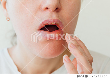 Close up of girl lips affected by herpes. Treatment of herpes infection and virus. Part of young woman face with finger touching pain on lips with herpes affected. Beauty dermatology concept. 75745562