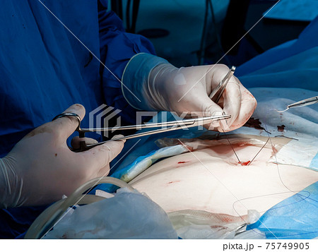 Doctors use medical instruments and metal thread to suture human skin. 75749905