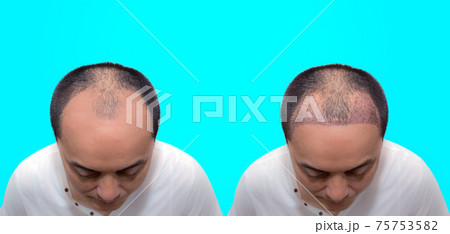 Close up top view of a man's head with hair transplant surgery with a receding hair line. before and after bald head of a man . Close up top view of a man's head with hair transplant surgery with a receding hair line. before and after bald head of a man . 75753582