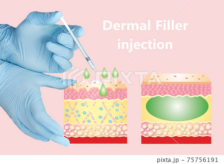 Cosmetic filler or dermal fillers 75756191