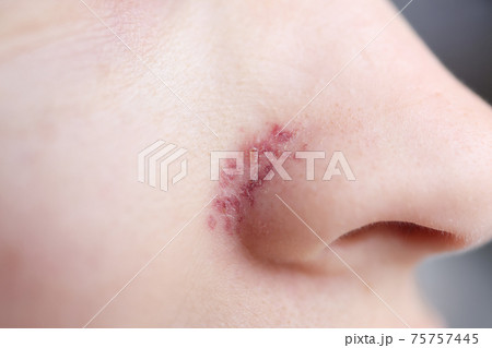 On wings of nose, skin after removal of vascular mesh On wings of nose, skin after removal of vascular mesh 75757445