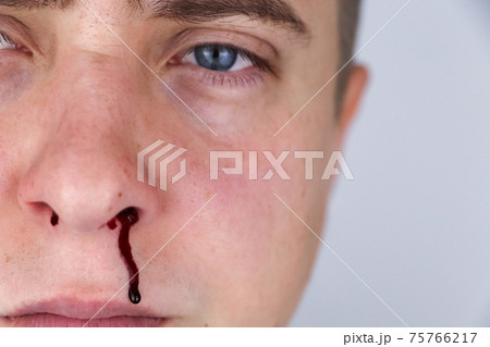 The man's nose started bleeding. High blood pressure caused blood vessels to rupture. A thin red trickle flows out of the sinuses. Consequences of vascular problems and severe stress 75766217