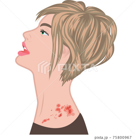 Shingles on a woman's shoulder. varicella-zoster vector illustration Shingles on a woman's shoulder. varicella-zoster vector illustration 75800967