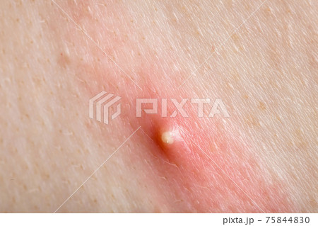 purulent pimple on inflamed human skin close-up, teen body health and problems. 75844830