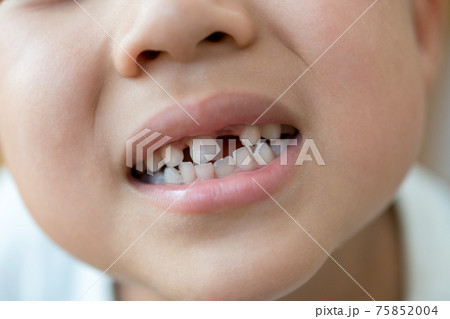 乳歯の生え変わり 75852004