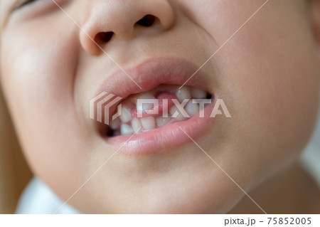 乳歯の生え変わり 75852005