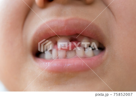 乳歯の生え変わり 75852007