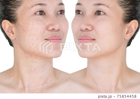 Before and after laser treatment 75854458