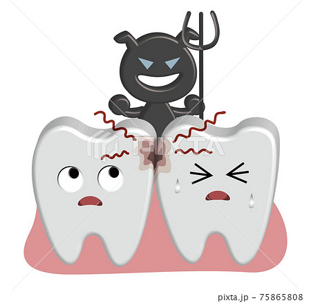 半立体のデンタルケアイラスト-虫歯菌が歯垢を栄養にして育つ 75865808