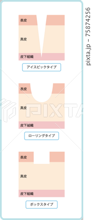 ニキビ跡の種類のイラスト素材